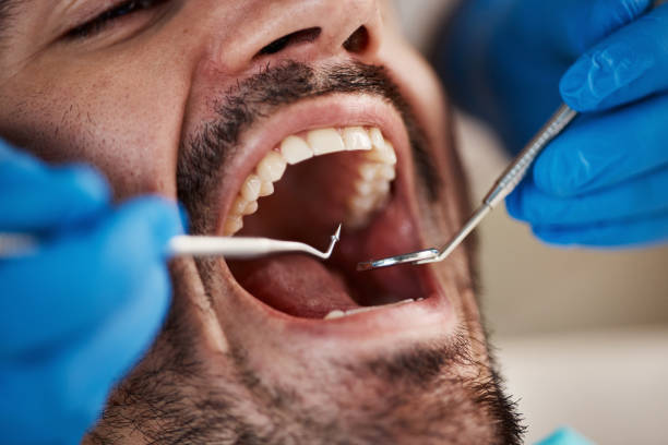 Best Emergency Dentist for Lost Fillings or Crowns in Dahlgren, VA