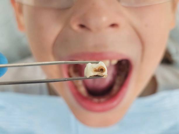 Best Emergency Root Canal Treatment in Dahlgren, VA