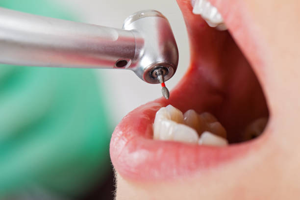 Best Emergency Dental Extractions in Dahlgren, VA